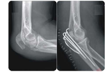 صور أشعة (X) لجزء من الهيكل العظمي